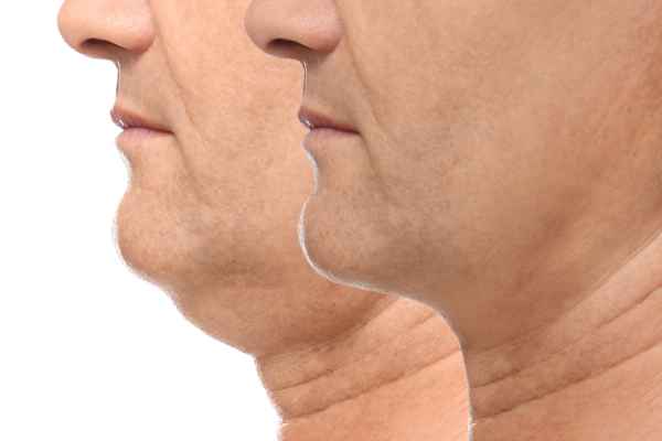 HIFU - Breakthrough in Anti - ageing 2 hifu results West Tilbury