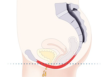 Pelvic-Floor Muscle Repair 5 Pelvic floor muscles West Tilbury