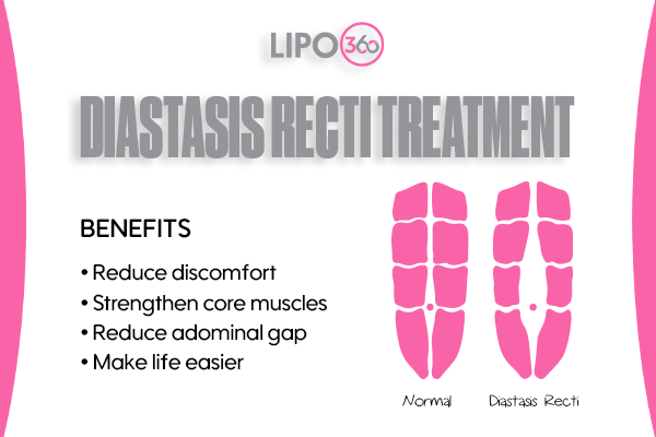 Revolutionising Muscle Repair: The Power of LIPO360 Body Sculpt Post-Injury 5 diastasis recti treatment West Tilbury