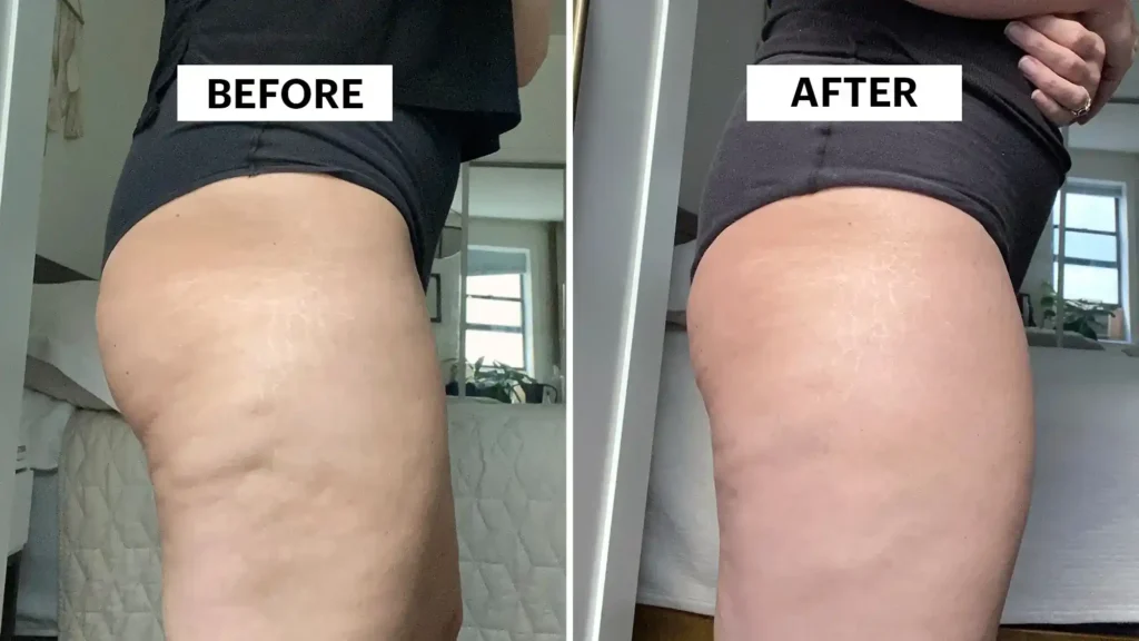 Do Toning Exercise West Tilbury Really Tackle Cellulite?
