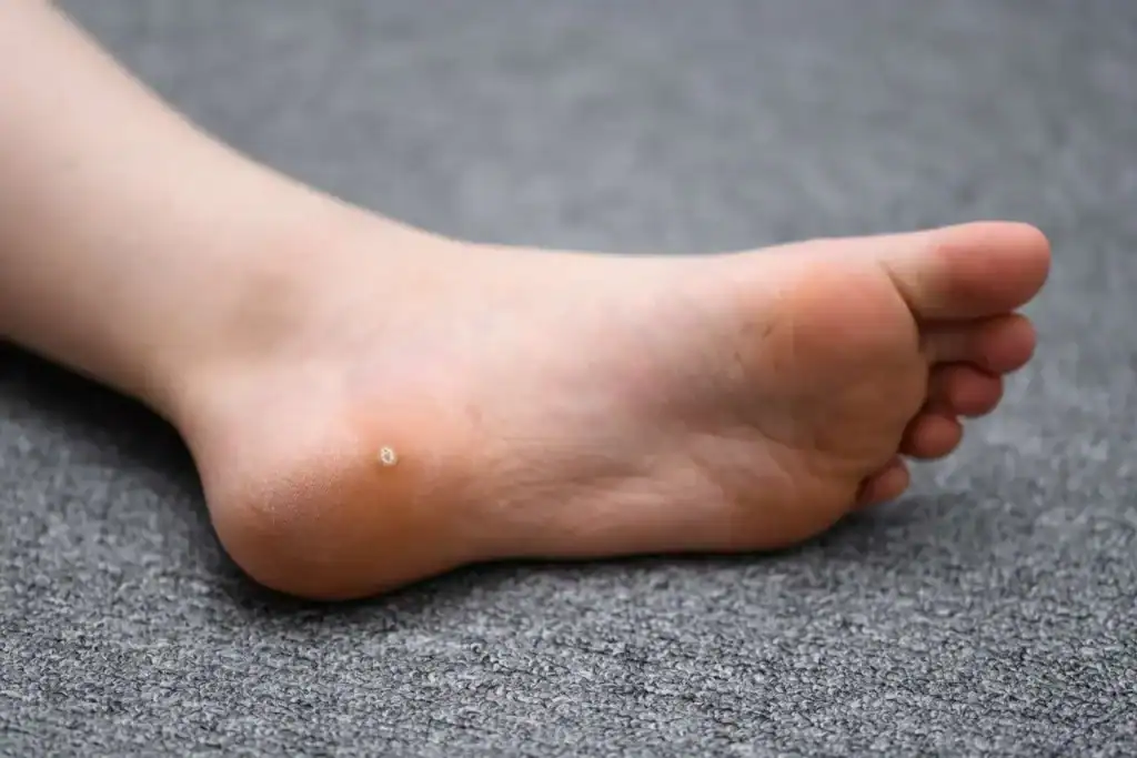 Cryotherapy For Warts And Also Verrucas 2 Image of verruca on the bottom of the foot that able to be treated with Cryotherapy West Tilbury