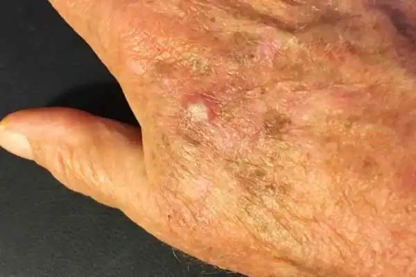 Cryopen For Actinic Keratoses 1 Image of Actinic keratoses West Tilbury on a person hand