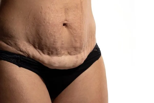 The Science of Skin Tightening 1 The science behind skin tightening West Tilbury picture of a woman's sagging skin on the stomach